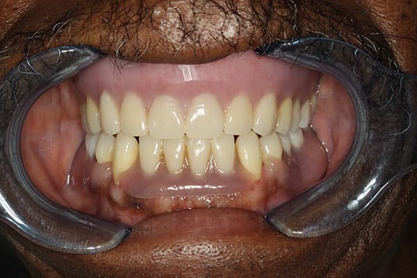 After complete dentures