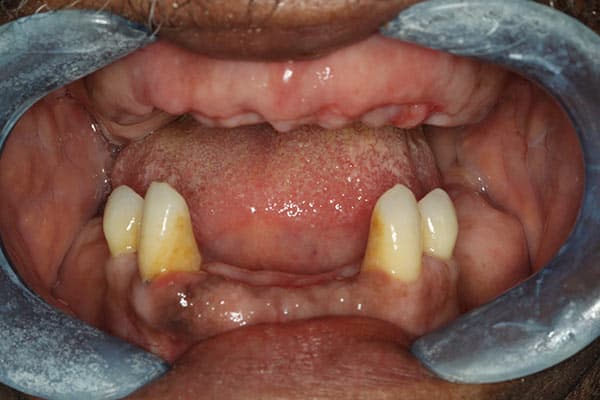 Before complete dentures