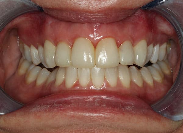 After complete dentures