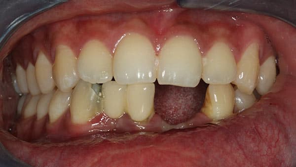 Before complete dentures