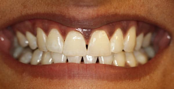 After complete dentures