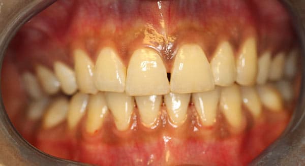 Before complete dentures