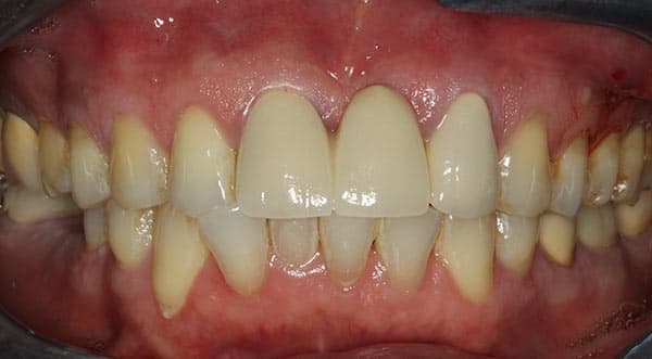 After complete dentures