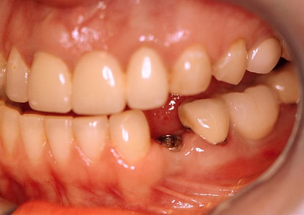 Before complete dentures