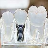 DENTAL IMPLANTS