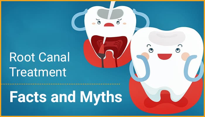 Root Canal Treatment: Facts and Myths