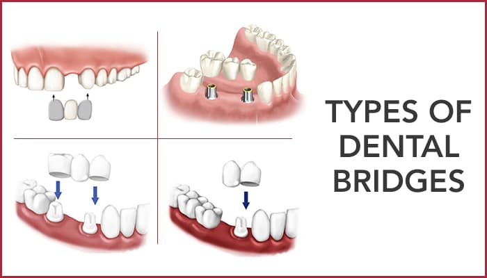Types of Dental bridges and why do you need it?