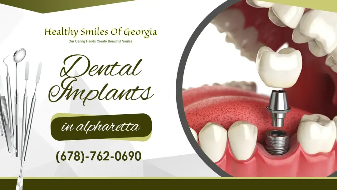 How to Take Good Care of Your Dental Implants
