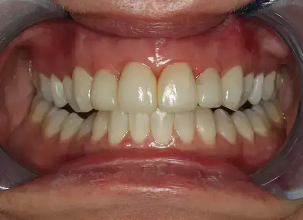 Porcelain Veneers after