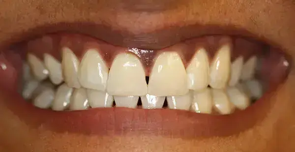 Zoom In-Office Teeth Whitening after