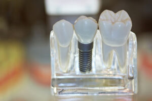 Dental Implants Are Growing in Popularity