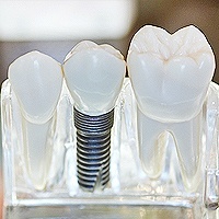 service dental implants