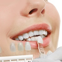 service dental veneers and dental laminates