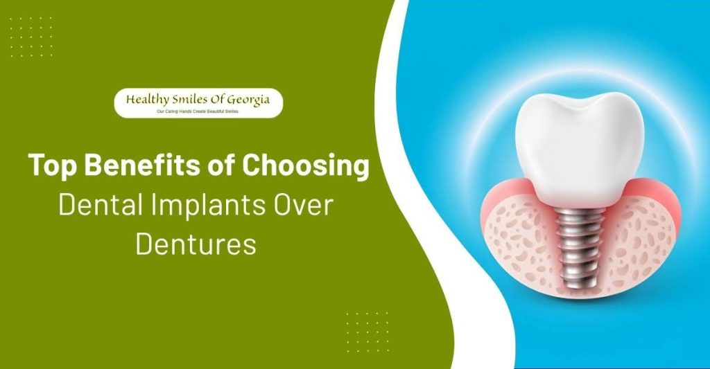 top benefits of choosing dental implants over dentures